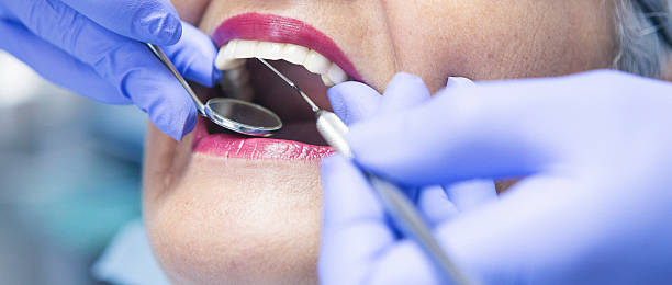 Best Emergency Dentist for Lost Fillings or Crowns in Yorkvle, IL