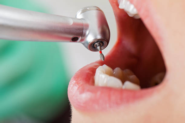 Best Broken or Cracked Tooth Emergency Dentist in Yorkvle, IL